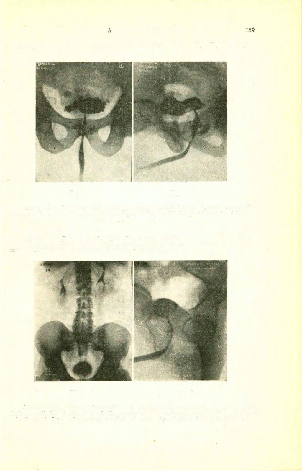 159 REVISTA ARGENTINA DE UROLOGÍA uretro prostático en forma radiada y múltiples diverticulos de la vejiga. Fig. I y 2 (l>us radiografías). Figura 1 Figura 2 F.