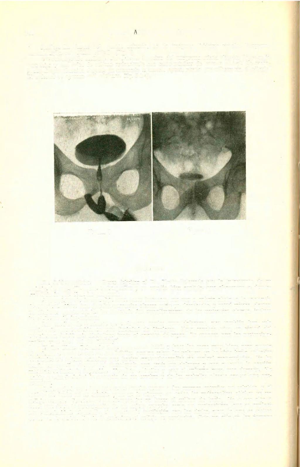 160 REVISTA ARGENTINA DE UROLOGÍA Radiografía simple del aparato urinario, no da imágenes litiásicas visibles. Urograma normal. Falta de relleno vesical. (Fig. 1).