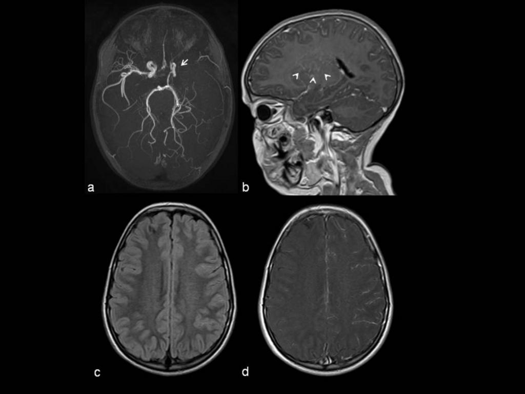 Fig. 5: DISPLASIA VASCULAR CEREBRAL. A) Severa estenosis de la arteria cerebral media izquierda (flecha).