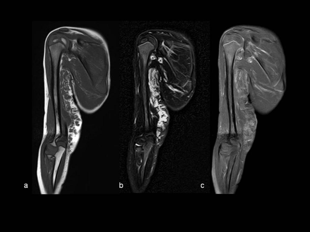 Fig. 7: NEUROFIBROMA EN BRAZO DERECHO. A) Imagen sagital T1 en la que se aprecia tumoración de partes blandas subcutánea en región axilar y cara interna del blazo, lobulada e isointensa al músculo.