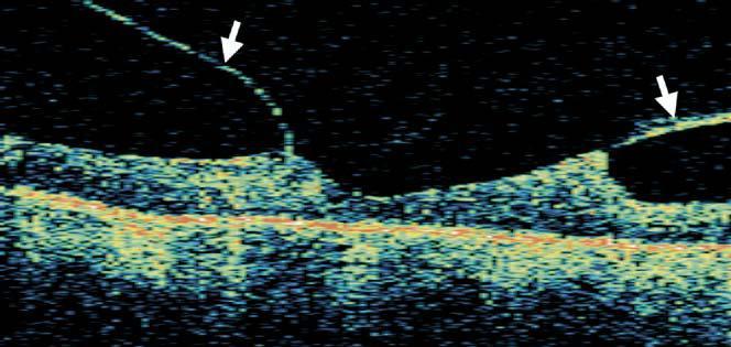 c.4) Tracción hialoidea posterior sin desprendimiento de retina traccional (tipo