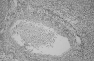 células T citotóxicas, si esto ocurre por necrosis directa o por liberación de citoquinas que inician la apoptosis, permanece incierto.