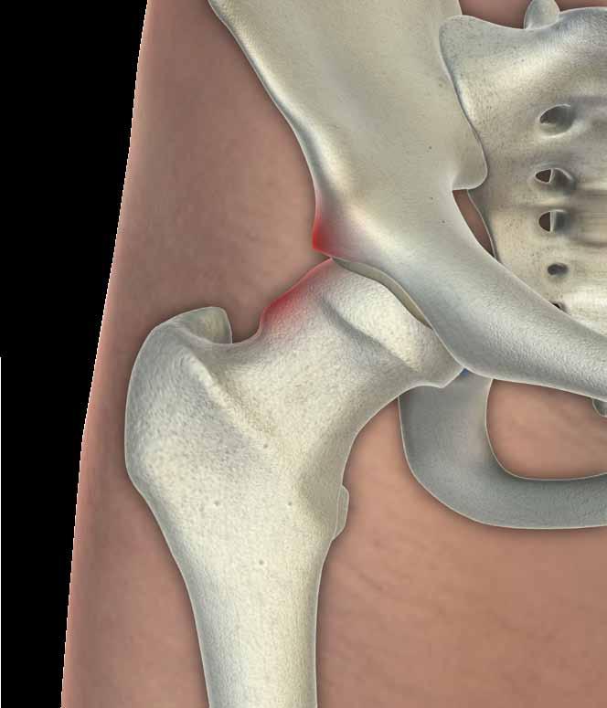 Conservación de tejidos Soluciones para cadera Los avances recientes en el conocimiento y el tratamiento del pinzamiento femoroacetabular han conducido al desarrollo de técnicas mínimamente invasivas