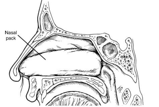 b) sponja nasal Marks SC: Nasal and sinus surgery,