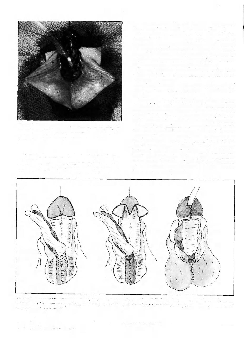 Figura 4: Uretra proximal terminada y fija en cara ventral del pene, tutorizada por el catéter de silastic.