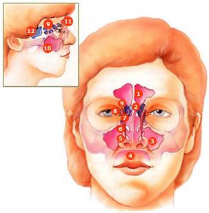 seno frontal seno esfenoidal seno maxilar cavidad oral cornete inferior cornete medio cornete superior saco lagrimal celdas aéreas etmoidales seno maxilar seno frontal seno esfenoidal Fuente: