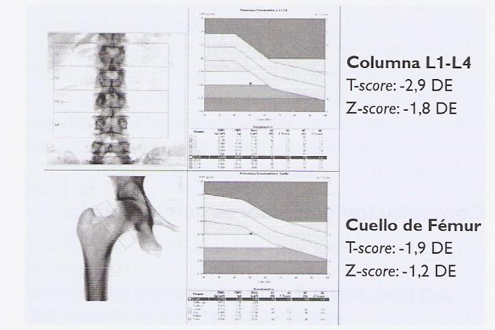 DE + fractura -3,5 Y -4,5 cada DE que disminuye la masa ósea, x2 La puntuación T compara la DMO del paciente con la media en una