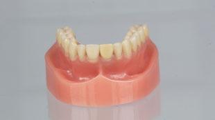 Inserte la restauración provisional en la boca del paciente con un torque de 15 Ncm.