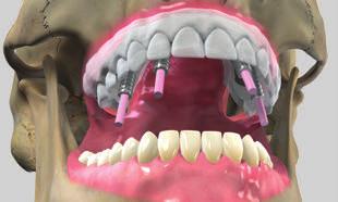 Sobre la base de la impresión dental, prepare el modelo maestro utilizando el procedimiento estándar. Con la impresión y el registro de mordida, confeccione la prótesis provisional.