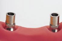 2. Restauración con postes synocta para provisionales (para RN y WN) Implantes RN con Ø de hombro 4,8 mm Implantes WN con Ø de hombro 6,5 mm N art. 048.