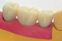 Realización en el laboratorio: El revestido de los postes puede realizarse adaptando dientes acrílicos prefabricados o modelando directamente la resina sobre el poste.