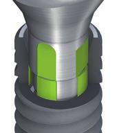 Colocación del pilar, paso 2. El pilar se gira hasta que sus muescas coincidan con los cuatro elementos de protección contra la rotación existentes en el implante. Colocación del pilar, paso 3.