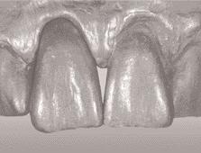 Complete la forma desde el área palatina utilizando masa incisal, de dentina y mamelones.