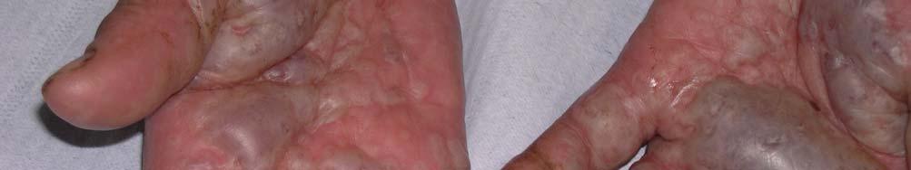 Esclerosis: induración de la piel con pérdida de los pliegues normales.