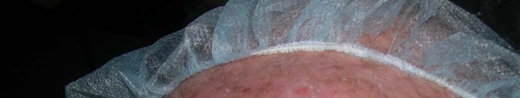 ABCDE en Urgencias Extrahospitalarias Queratoacantoma: tumor excrecente con centro umbilicado relleno de queratina.