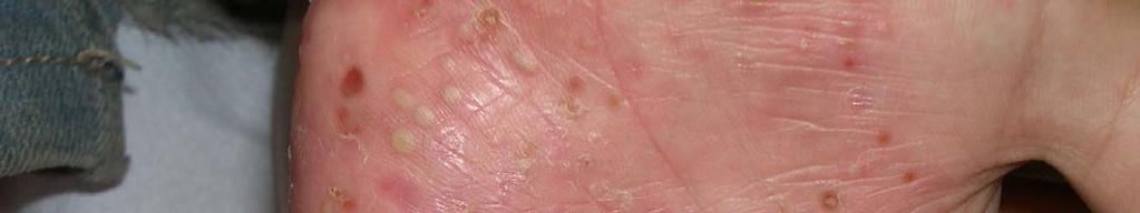 ABCDE en Urgencias Extrahospitalarias Lesiones localizadas en manos Dermatitis de contacto (irritativo o