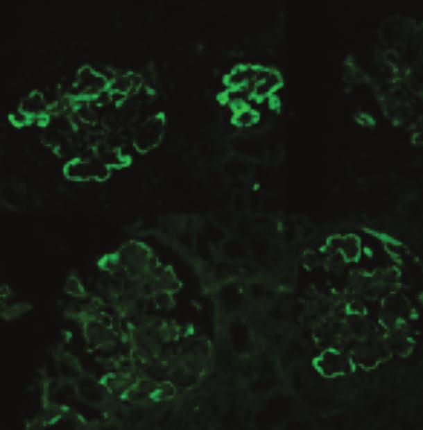 En la inmunofluorescencia se encontraron depósitos confluentes localizados en la membrana basal capilar glomerular positiva para IgG, IgA, IgM C3 y C1q, y en la microscopia electrónica se halló