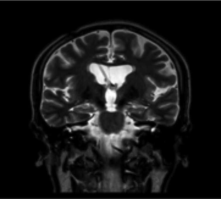 111 Se le realiza una resonancia magnética cerebral (figura 2), que señala una adecuada posición de la derivación ventriculoauricular. El ecocardiograma transesofágico se reporta sin vegetaciones.