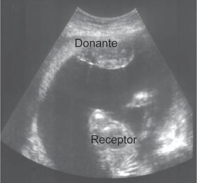 Figura 3. Síndrome de transfusión feto-fetal severo a las 20 semanas de gestación.