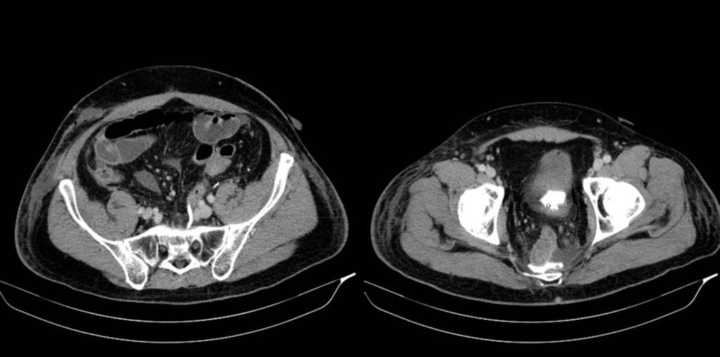 Fig. 5: Paciente de 52 años Intervenido de ca recto en Abril/12 En postoperatorio, recorte de diuresis y aumento de débito por herida quirúrgica (zona perianal).