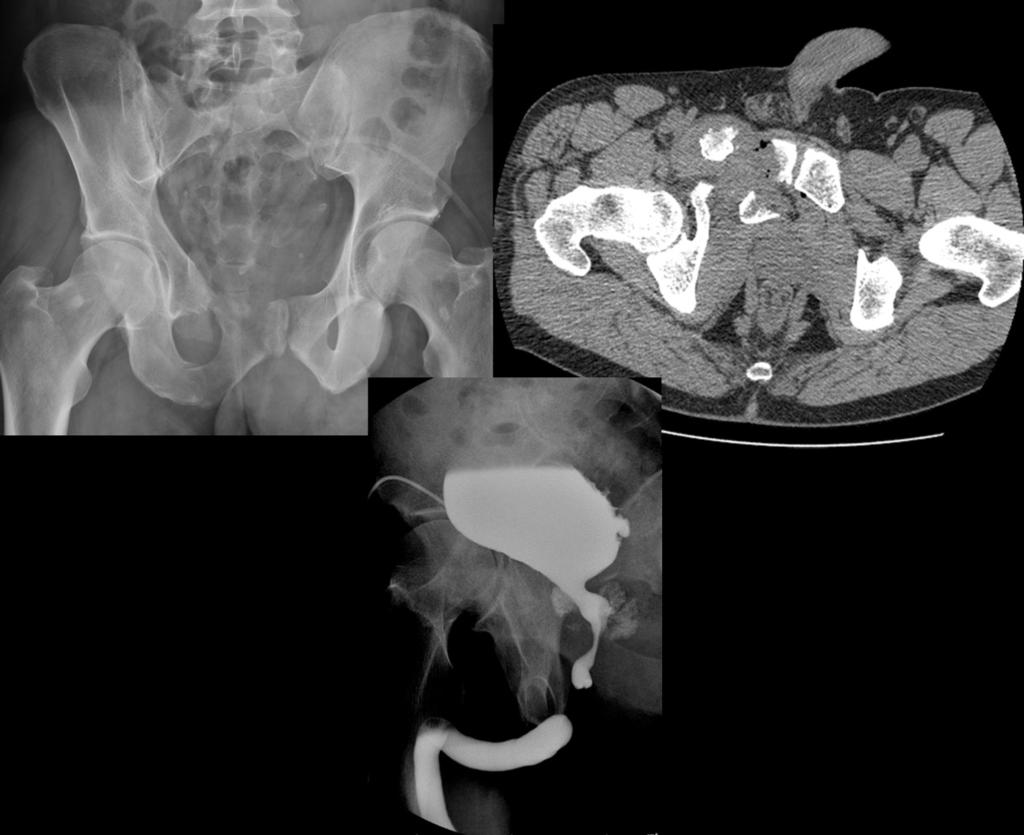 Fig. 10: Se observa estrechamiento de la uretra prostática por estiramiento y membranosa pero indemnidad de la misma. Rotura uretral tipo I Fig.