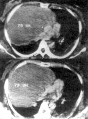 Tomografía computada. Masa sólida, homogénea, bien limitada que ocupa gran parte del hemitórax derecho, desplaza el corazón y los vasos adyacentes.
