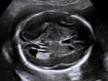 Ventriculomegalia leve Evaluación Ecográfica Corte axial de la cabeza fetal, en el plano transventricular.