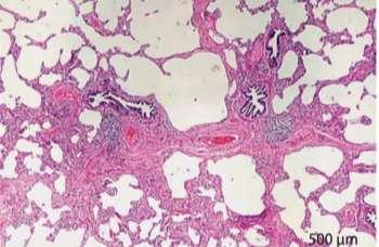 Fibrosis Centrolobulillar Fibrosis,