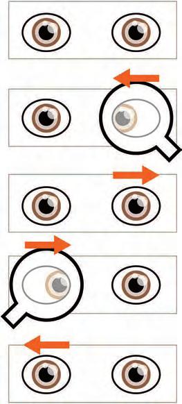 En caso de una tropía (desviación ocular manifiesta que no puede ser controlada), el reflejo estará desplazado en el ojo desviado (figura 1).
