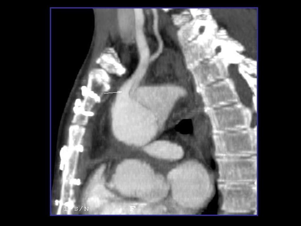 Fig. 7: Reconstrucción multiplanar de angio-tc de aorta torácica con contraste