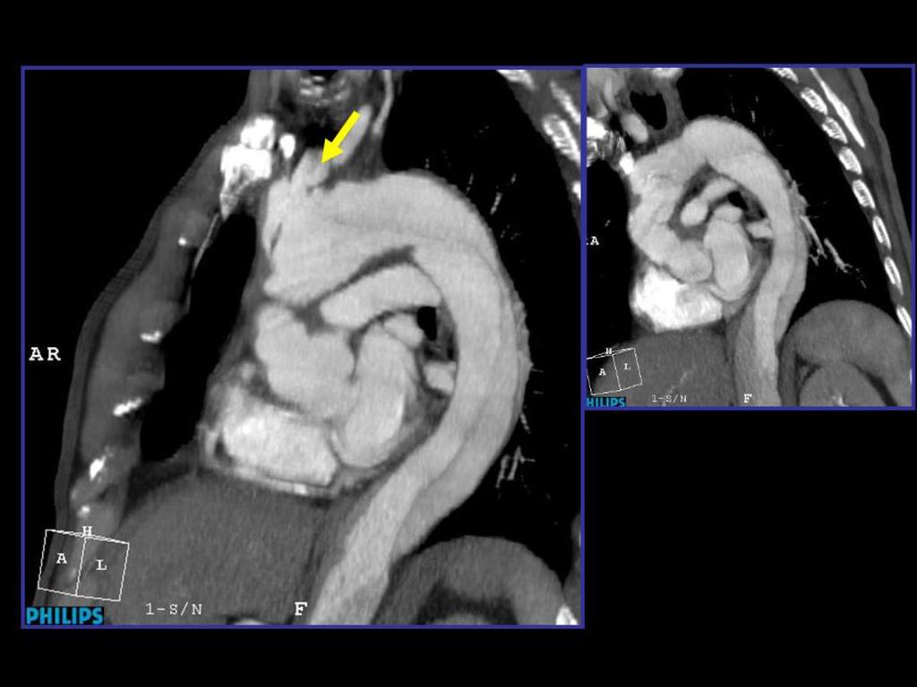 Fig. 8: Reconstrucciones multiplanares de angio-tc de aorta torácica con contraste donde