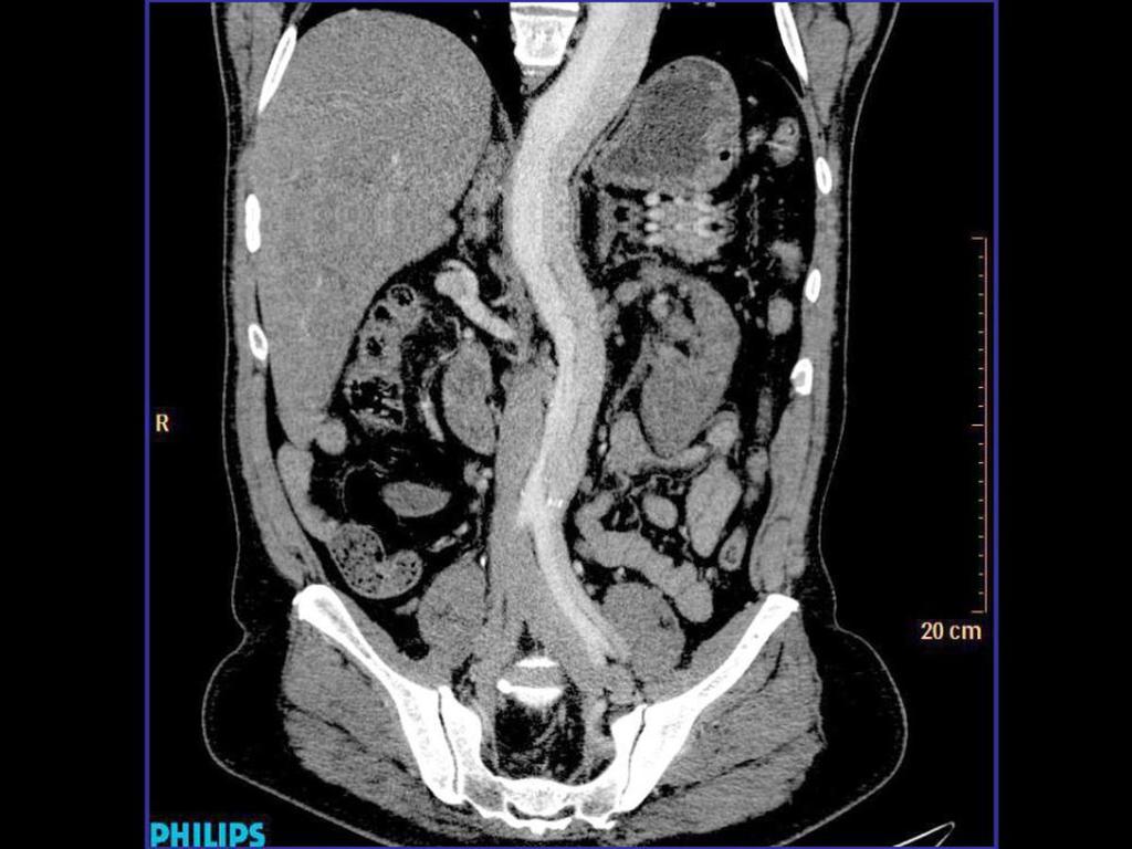 Fig. 10: Imagen en el plano coronal de angio-tc de aorta donde se aprecia extensión de la disección