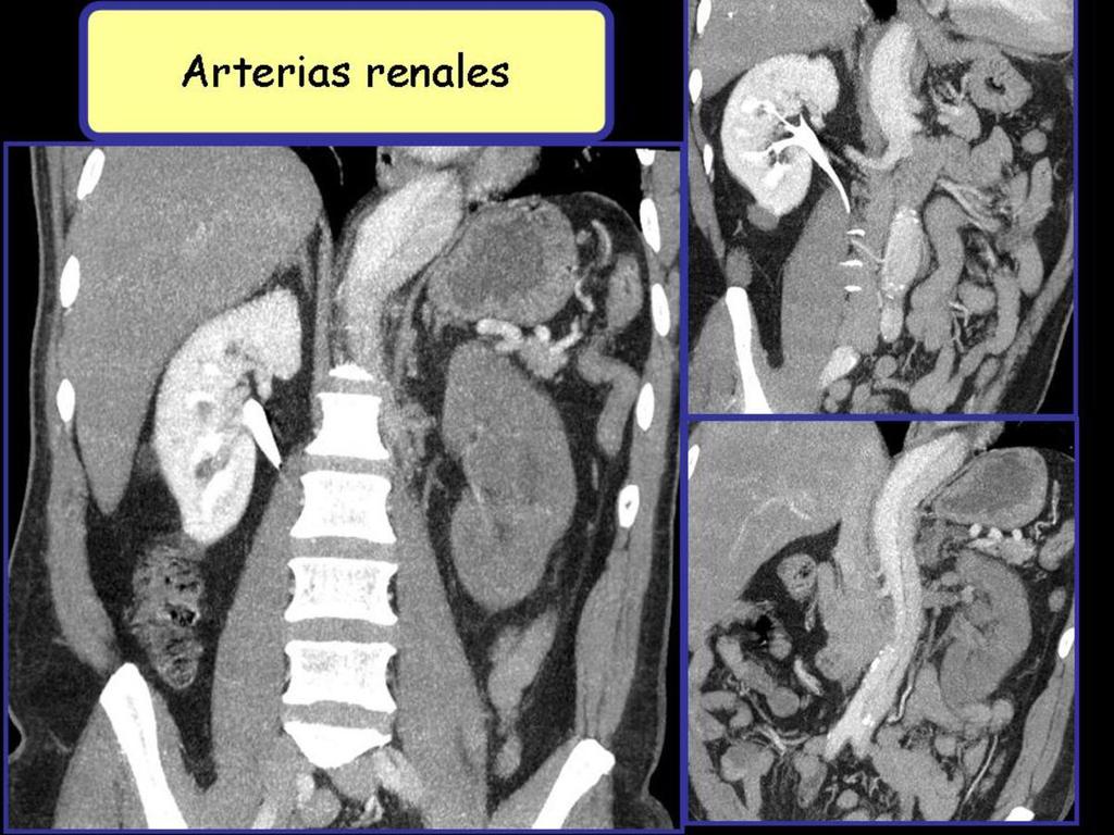 Fig. 11: Reconstrucción multiplanar de angio-tc de aorta con contraste donde se aprecia extensión de la disección de la aorta torácica hasta la aorta