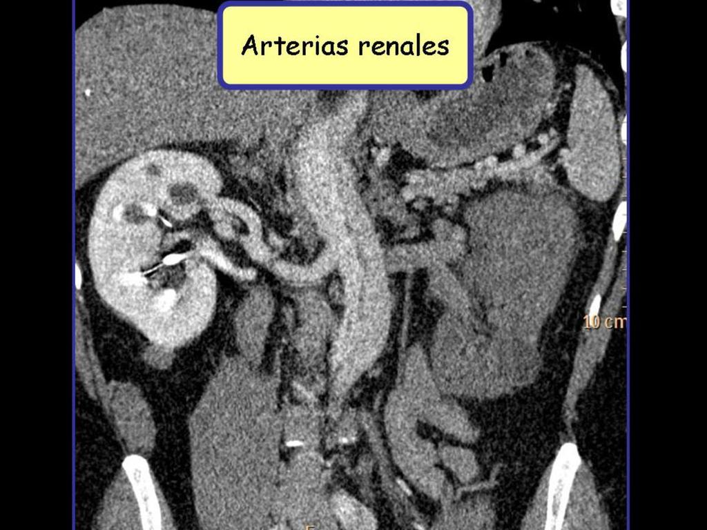 Fig. 12: Reconstrucción en el plano coronal de angio-tc de aorta con contraste donde al igual que en el caso anterior se aprecia extensión de la disección