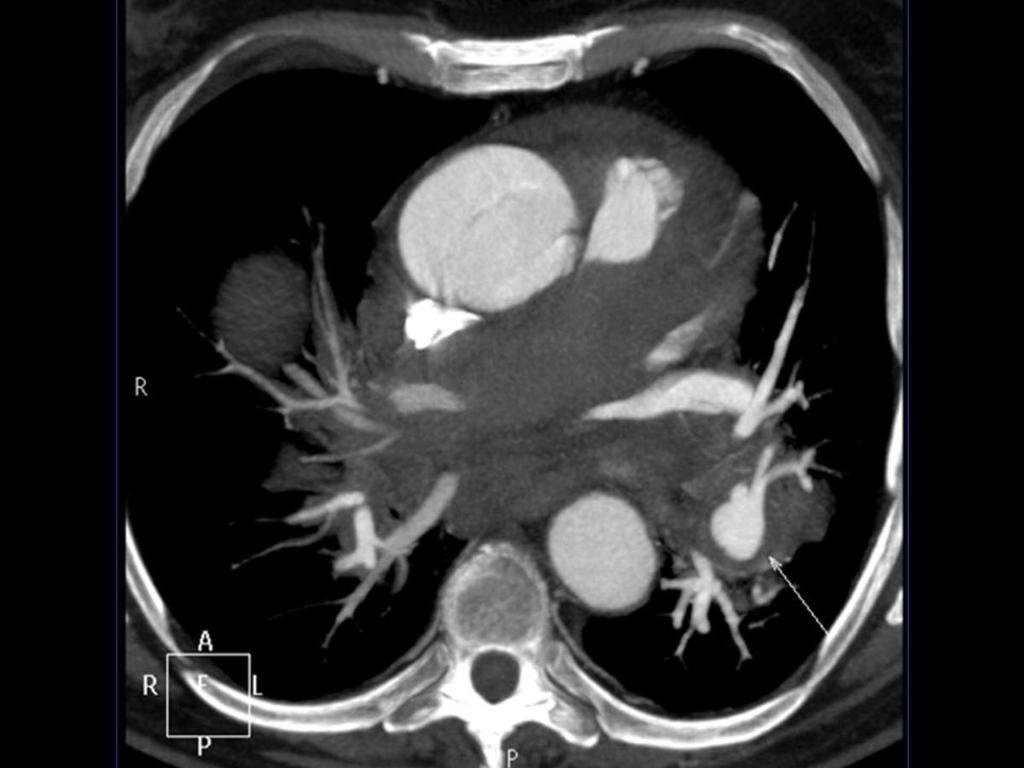 Fig. 13: Imagen axial de angio-tc de aorta torácica con contraste donde se aprecia extenso hematoma mediastínico con disección de la vaina de las arterias pulmonares y extensión del hematoma a las