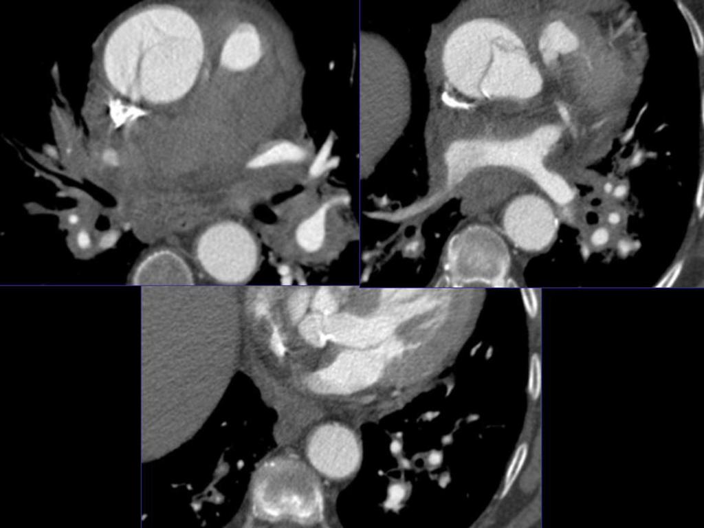 Fig. 14: Reconstrucciones multiplanares de angio-tc de aorta torácica con contraste donde se aprecia un extenso hematoma