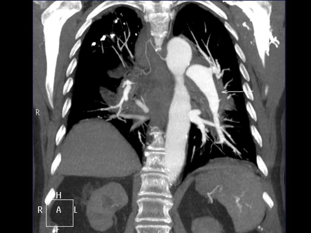 Fig. 16: Reconstrucción en el plano coronal de angio-tc de aorta torácica con contraste donde se aprecia un hematoma
