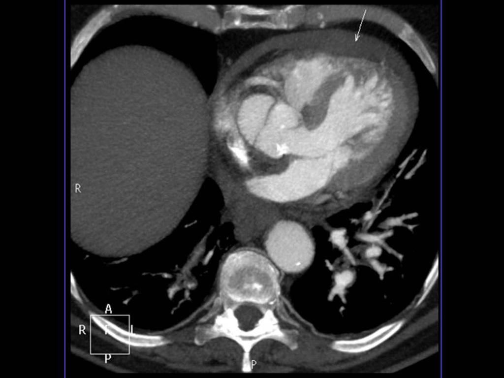 Fig. 2: Corte axial de angio-tc de aorta torácica con contraste donde se aprecia derrame