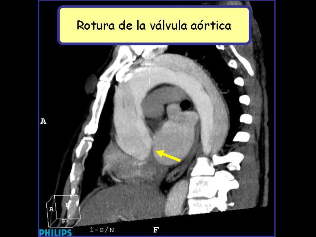 Fig. 3: Imagen en plano sagital de angio-tc de aorta torácica donde se aprecia extensa disección de aorta que