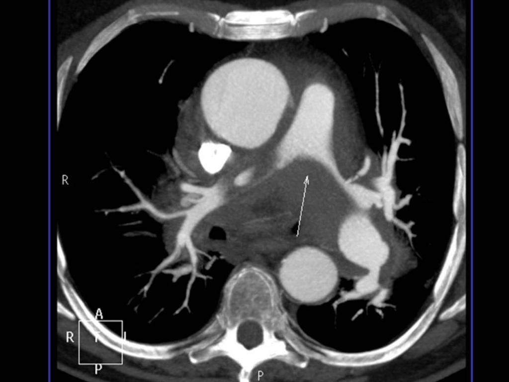 Fig. 4: Imagen axial de angio-tc de aorta torácica donde se aprecia la presencia de un hematoma mediastínico que se