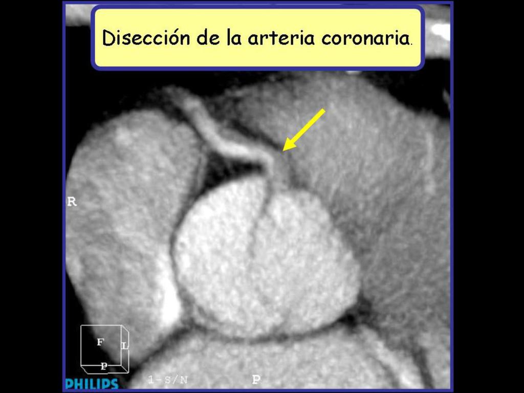 Fig. 5: Reconstrucción multiplanar de angio-tc de aorta torácica donde se aprecia extensión de la disección de aorta