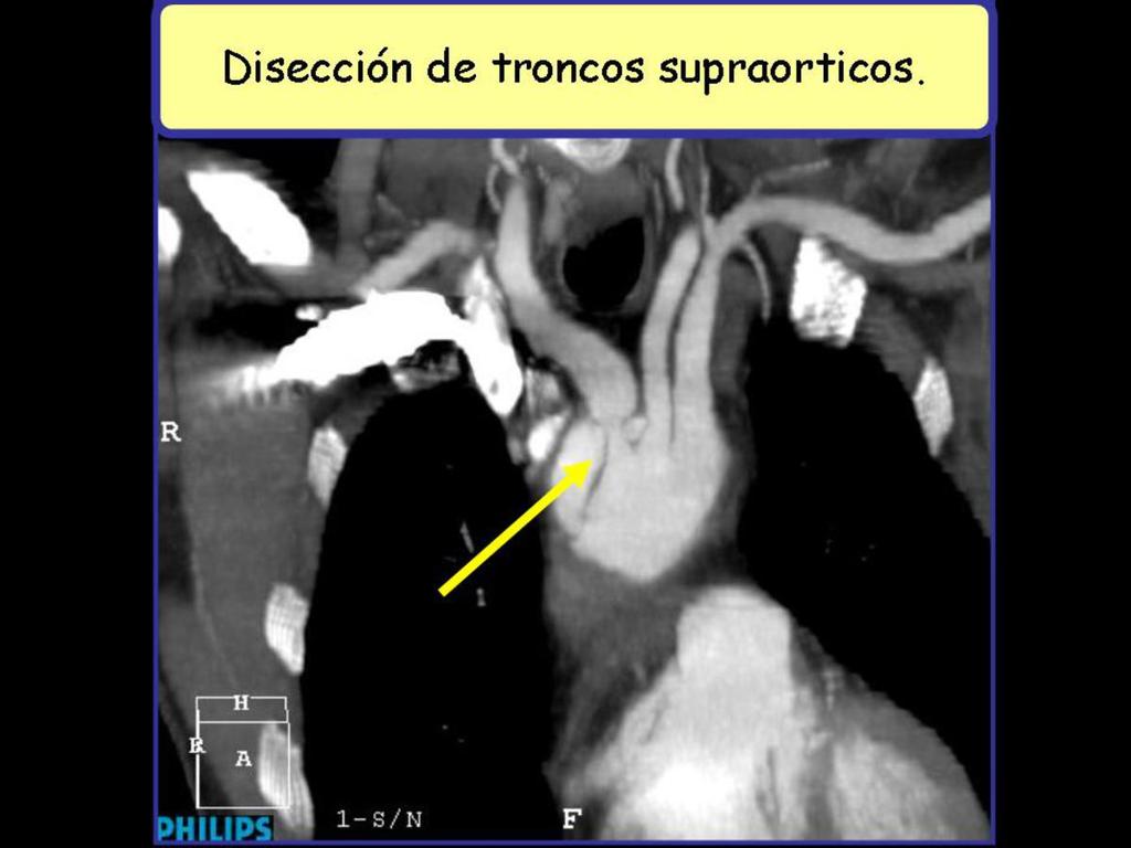 Fig. 6: Imagen en el plano coronal de angio-tc de aorta torácica con contraste donde se aprecia