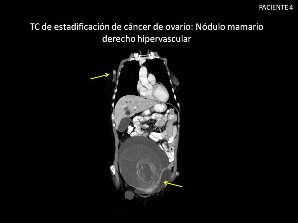 Fig. 14: Paciente de 62 años con diagnóstico de tumor mucinoso borderline ovárico.