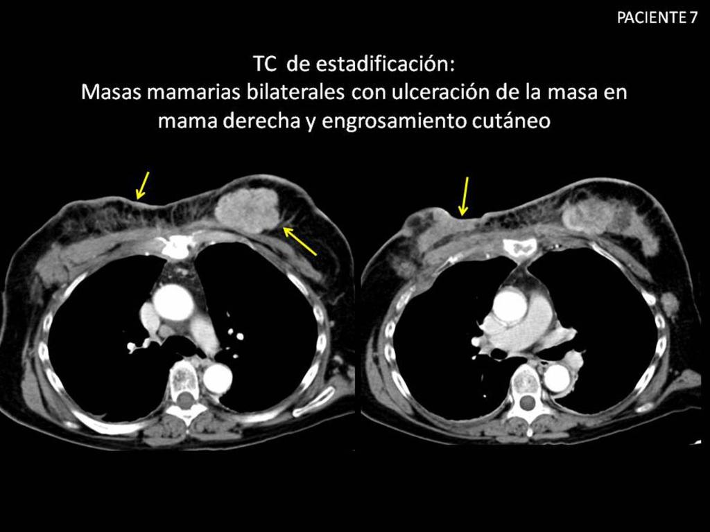 Fig. 23: Mujer de 59 años con carcinoma ductal infiltrante de mama bilateral.