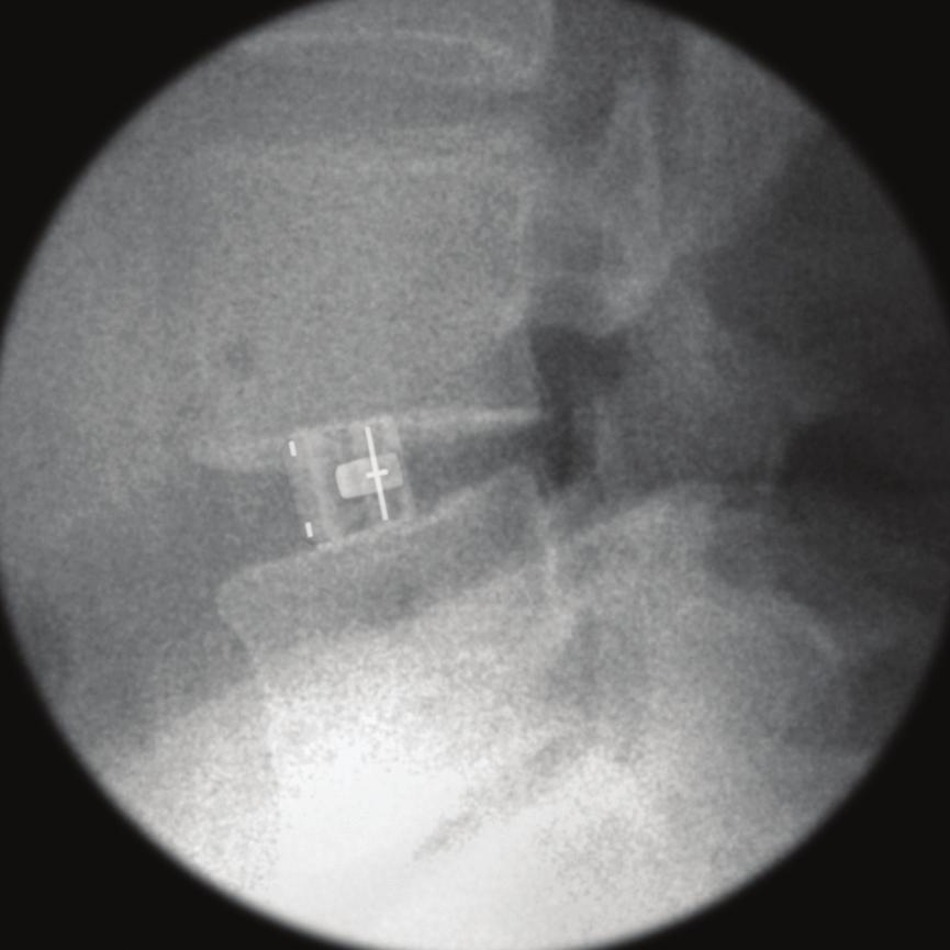 Altura total del marcador posterior del implante El mecanismo articulado del portaimplantes proporciona angulación variable y fija Marcador horizontal a través del