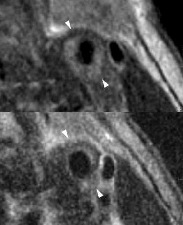Magnetic Resonance Imaging of Carotid Atherosclerotic Plaque in Clinically