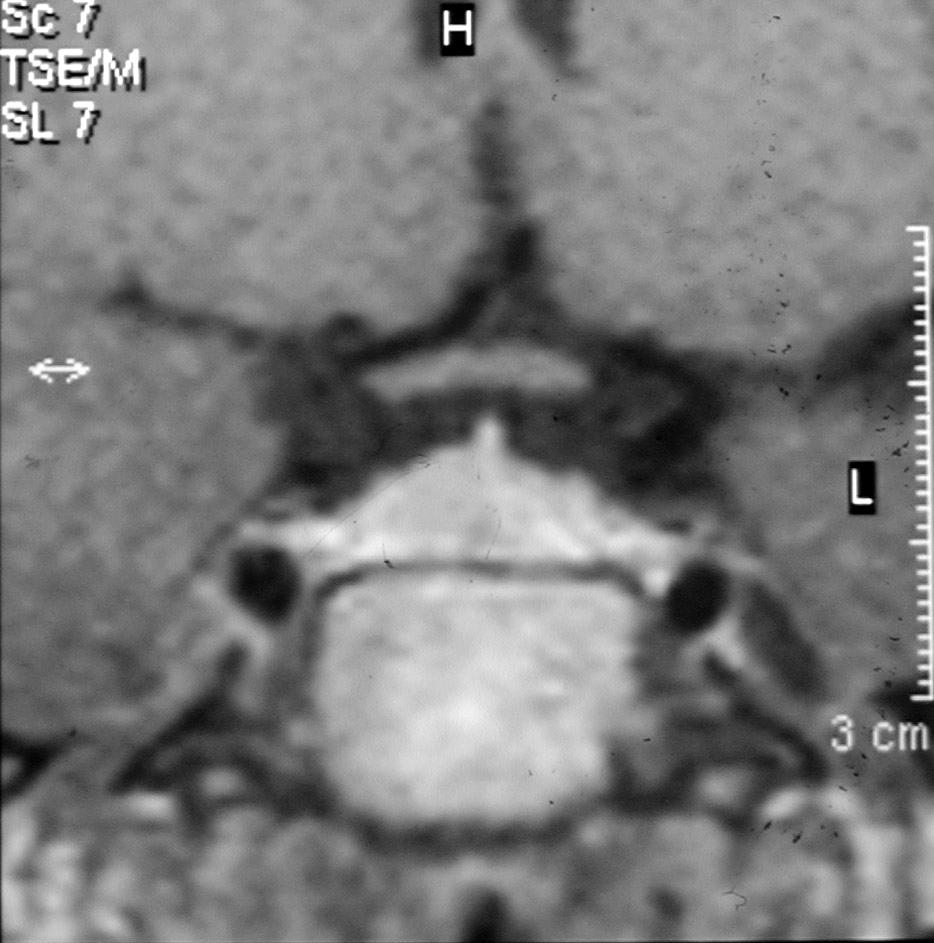 PRL :200 ng/ml Paciente 45 años Por cefaleas RMI: compatible con microadenoma Sin clinica de HiperPRL. Recibe Cabergolina hasta 1,5mg/semana.