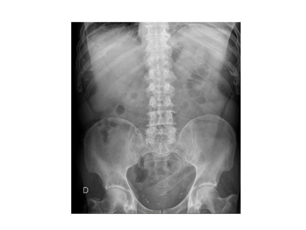 Fig. 4: Radiografía simple de abdomen a las 24 horas del procedimiento
