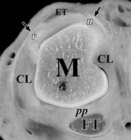 MCF * Dorsal transversal tendón cabeza metacarpo,