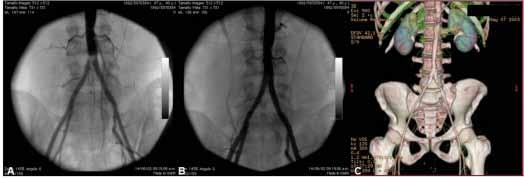 Se practicó aortografía, la cual mostró obstrucción subtotal del 80 % de la aorta abdominal distal.